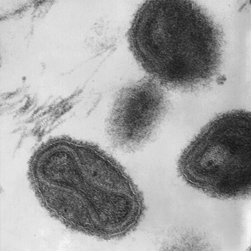 Micrograph of Smallpox